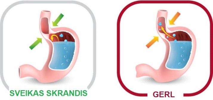 Gastroezofaginio refliukso liga (GERL) 